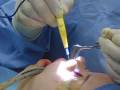 Rhinoplasty In the Operating Room - Turbinate Reduction