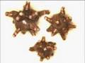 Kidney Stones home remedies and cures kidney stones