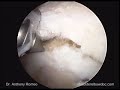 From Open to Arthroscopic Rotator Cuff Repair with Anthony A. Romeo, M.D., Part 5 From Open to Arthroscopic Rotator Cuff Repair with Anthony A. Romeo, M.D., Part 5