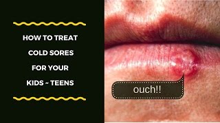 How To Treat Your Child's Cold Sore