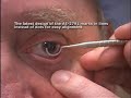 INSTRUMENT SET FOR IMPLANTATION OF THE TORIC LENS