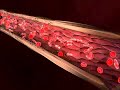 Medical Animation | Clotted Blood Vessels