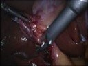 Laparoscopic Cholecystecectomy