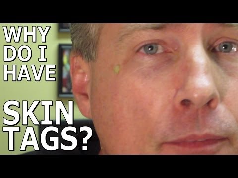 how to prevent skin tags