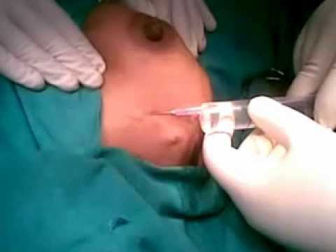 how to drain cyst in breast