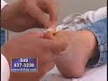 Bunion Surgery Expert Dr. Moy Segment 4 of 5