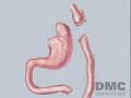 Weight-Loss Surgery for Chronically Obese Weight-Loss Surgery for Chronically Obese