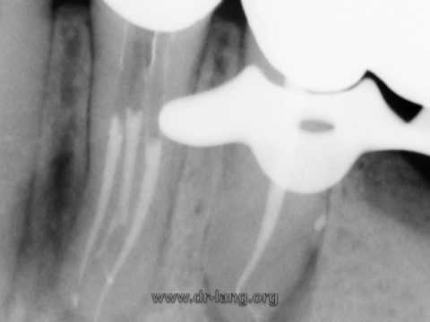 Endodontic treatment: lower premolar ...