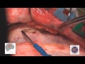 Abordaje pterional con diseccion interfascial