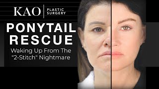 Botched Plastic Surgery Nightmare! Ponytail Facelift Before and After - Kao Plastic Surgery Review