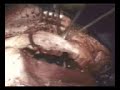 Craniofacial Resection & Reconstruction