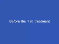 Outcomes of treatment for Lisfranc sprain on her left foot -