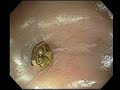 Cleaning Diverticulosis