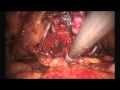 Endoscopic Radical Prostatectomy - Robot Assistance