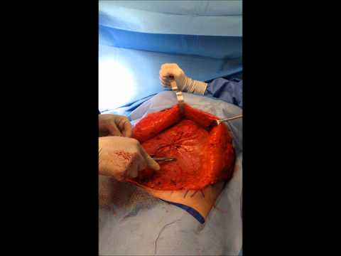 how to repair muscle