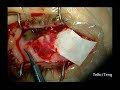 Amniotic Membrane Transplant for Bleb Leak