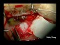 Amniotic Membrane Transplant for Bleb Leak