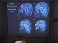 Dr. Sidney Kennedy, Deep Brain Stimulation Pt.4
