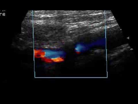 how to eliminate aliasing ultrasound