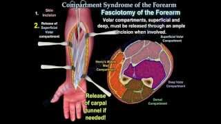 Compartment Syndrome Of The Forearm - Everything You Need To Know - Dr. Nabil Ebraheim