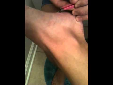 Girl with thorn in foot