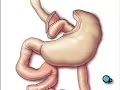 PreOp® Patient Education: Gastric Bypass Laparoscopic Surger