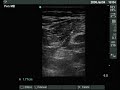 Ultrasound view of the sciatic nerve (transgluteal)
