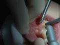 Frenectomy