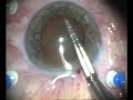 Micro-incision cataract surgery (MICS)