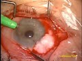Trabeculectomy Revision Left eye