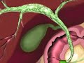 Biliary Stricture Biliary Stricture