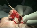 Rinofima - Dr. Nelson Heller