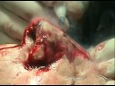 Rinofima - Dr. Nelson Heller