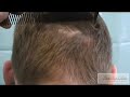 Hairline creation by FUE: The role of nape hair - Dr Umar