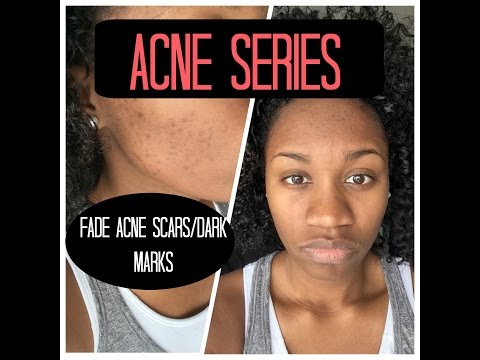 Acne Series | Fading Dark Marks/ Acne Scars & Skin Care Regimen | EiffelCurls