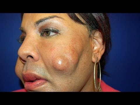 Cosmetic Surgery Disaster: Woman Dubbed 'Cement Face' Given New Lease Of Life