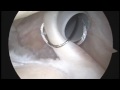 Arthroscopic Shoulder Surgery- Biceps Tenodesis (Buford) Arthroscopic Shoulder Surgery- Biceps Tenodesis (Buford)