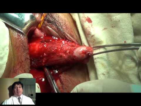 vejiga caida - DR. RAUL PILCO P. GINECOLOGO 0998242587 DR. FERNANDO VALLEJO T. GINECOLOGO 0997096866 DR. PAUL DAVILA. ANESTESIOLOGO TECNICA DE LE FORT MODIFICADA POR PILCO....
