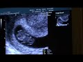 ultrasound2,,
