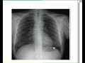 Respiratory system, X ray Chest, Pneumonia Respiratory system, X ray Chest, Pneumonia