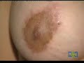 asombroso peligro de cirugia de tetas senos pechos silicona2