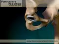 Orthopaedic Hip replacement surgery in India at Chennai.