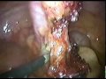 Apendicitis
