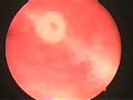 Laparoscopy Diagnostic Hysteroscopy