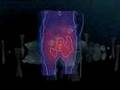 Video Describing Hyperthermia Cancer Treatment