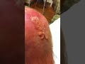 Lancing mrsa part 4