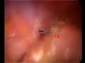 Appendicite (appendicitis) acuta flemmonosa, appendicectomia laparoscopica. Appendicite (appendicitis) acuta flemmonosa, appendicectomia laparoscopica.