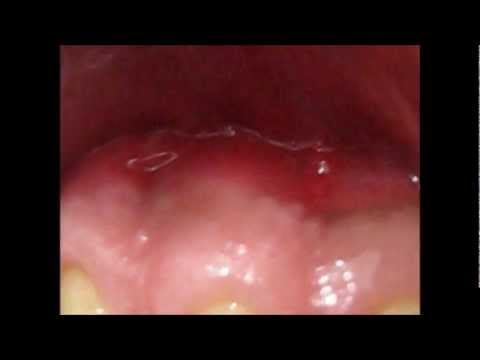 how to drain a mouth ulcer