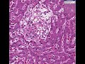Histopathology Liver --Cryptococcosis Cryptococcosis