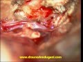 brain tumor- olfactory groove meningioma-microsurgery-dr suresh dugani/HUBLI/INDIA